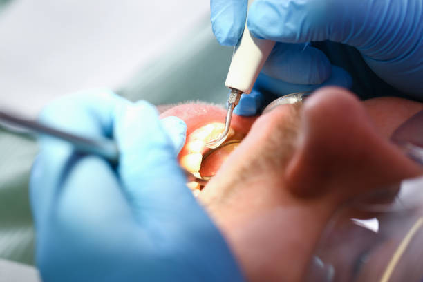 Best Emergency Root Canal Treatment in Hampton, MD